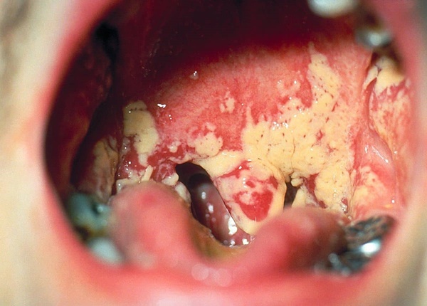 Bệnh nấm lưỡi ở người lớn là bệnh gì?