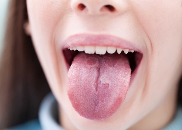 Nguyên nhân nào gây ra bệnh nấm lưỡi?