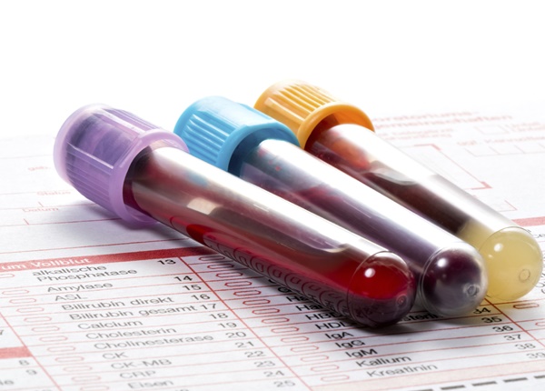 Chỉ số xét nghiệm máu MCV là gì và ý nghĩa của nó