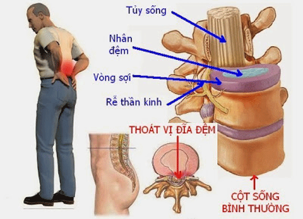 Triệu chứng của bệnh thoát vị đĩa đệm thường những cơn đau nhức vùng thắt lưng