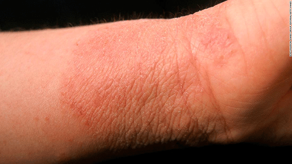 Tình trạng người mắc bệnh Eczema