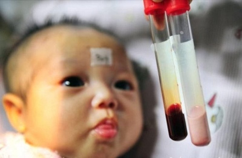 bệnh tan máu bẩm sinh beta thalassemia thường gặp ở trẻ em