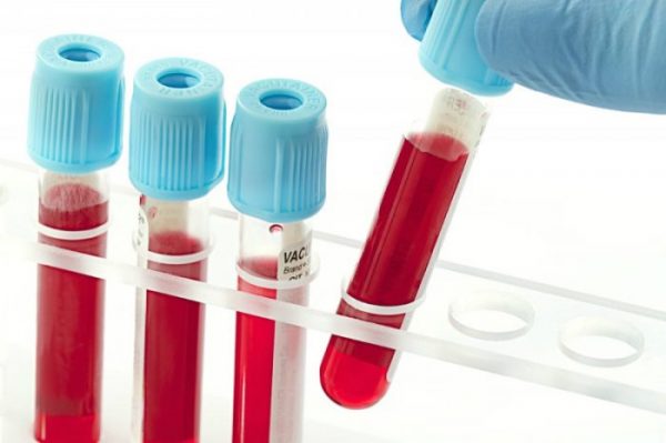 Xét nghiệm công thức máu có vai trò rất quan trọng với sức khỏe