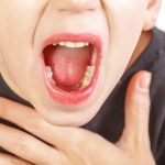 Viêm họng và cách điều trị