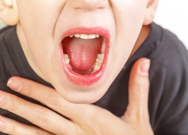 Viêm họng và cách điều trị