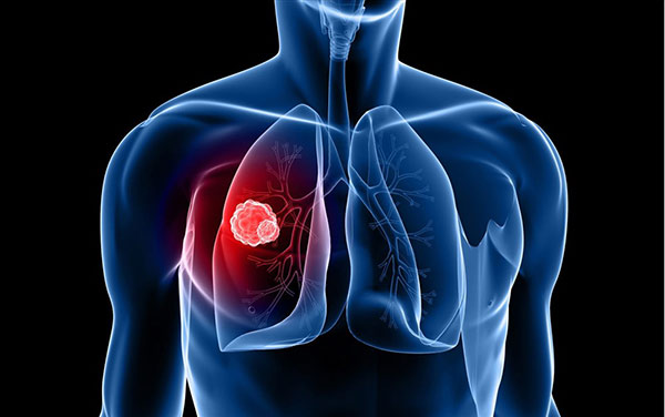 9 dấu hiệu giúp nhận biết sớm ung thư phổi