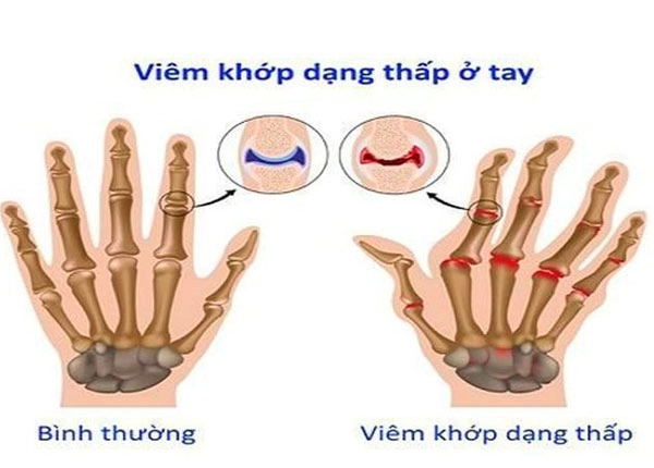 Viêm khớp dạng thấp ở tay