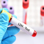 Tầm quan trọng của xét nghiệm LDH đối với sức khỏe