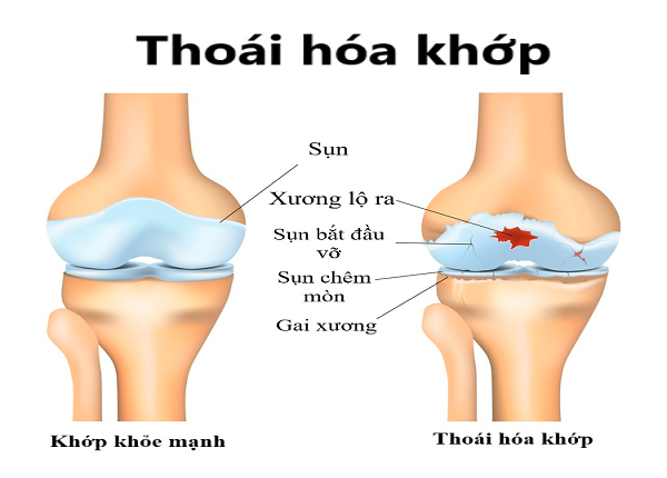 Thoái hoá khớp thường xuất hiện ở những người cao tuổi