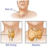 Bệnh Basedow là bệnh gì, các triệu chứng của bệnh Basedow?