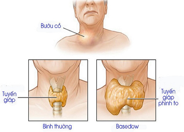 Nếu không trị kịp thời, bệnh Basedow có thể gây ra biến chứng nguy hiểm, thậm chí tử vong