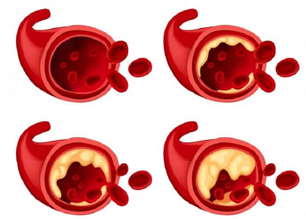 Người bị rối loạn lipid máu tiềm ẩn mối nguy bị đột quỵ 