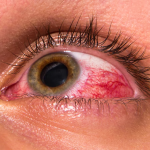 Nguyên nhân và tác hại của việc mắt nổi gân đỏ là gì?