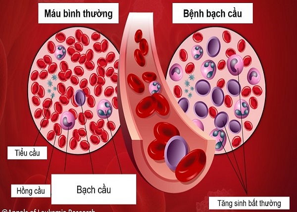 Ung thư máu là bệnh lý ác tính nguy hiểm