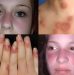 Bệnh Lupus Ban đỏ