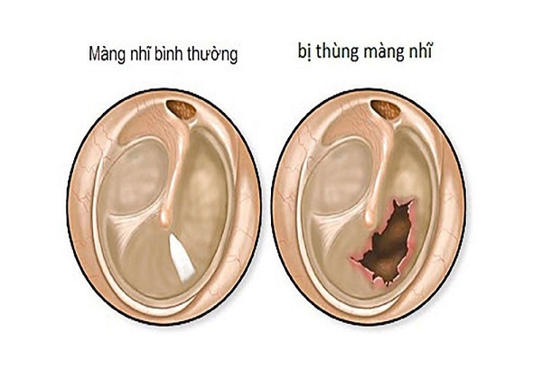 <center><em>Thủng màng nhĩ là tình trạng lớp mô mỏng ngăn cách giữa ống tai ngoài và tai giữa bị rách hoặc thủng</em></center>