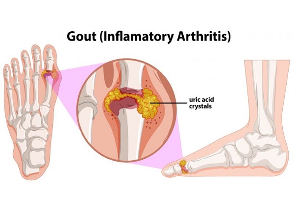 <center><em>Gout đặc trưng bởi hạt tophi quanh khớp, gây tổn thương và ăn mòn</em></center>