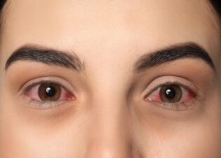 Bệnh đau mắt đỏ có thể lây lan nhanh chóng