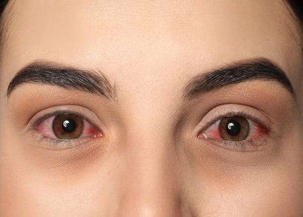 Bệnh đau mắt đỏ có thể lây lan nhanh chóng