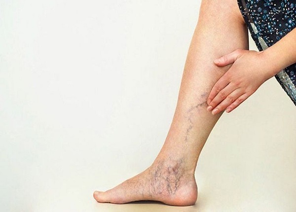 Người bị giãn tĩnh mạch chi dưới thường băn khoăn không biết nên lựa chọn hình thức vận động nào phù hợp