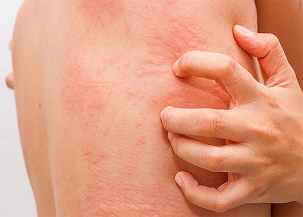 Phát ban da là tình trạng phổ biến