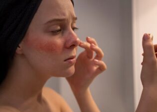 Ánh nắng mặt trời có thể gây viêm da tiếp xúc ánh sáng