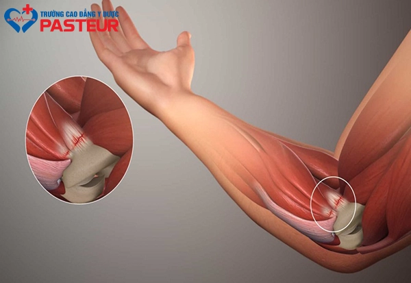 Tại sao cần đến bài tập Phục hồi chức năng khớp khuỷu tay