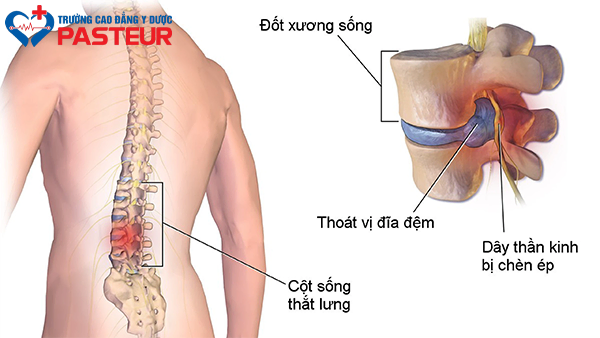Bệnh thoát vị đĩa đệm là gì?
