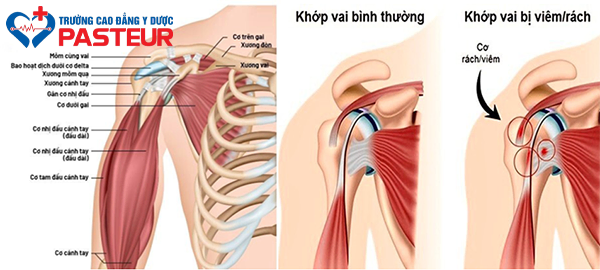 Bệnh lý viêm quanh khớp vai là gì?